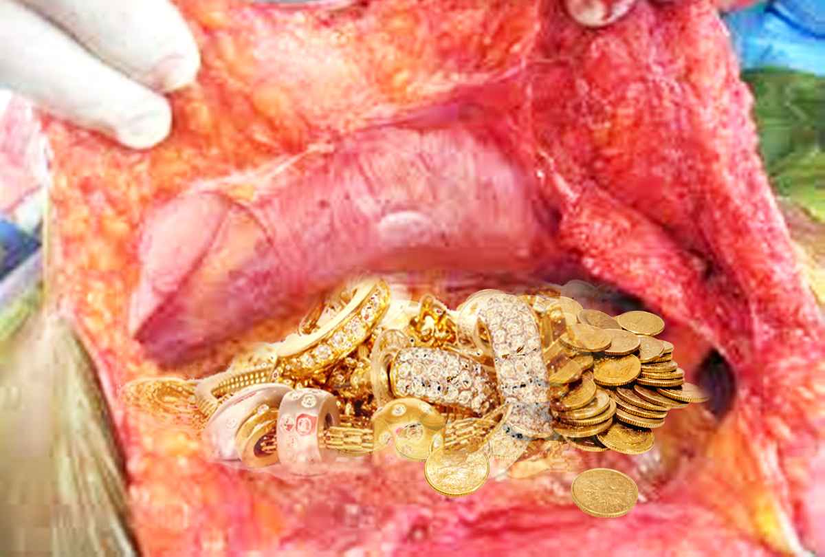 1.5 kg jewelry, coins extracted from the woman's stomach